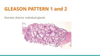 Pattern 3 Prostate MORPHOLOGICAL PATTERNS OF PROSTATE TUMORS.pptx