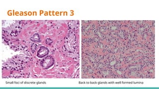 Prostate Pattern D MORPHOLOGICAL PATTERNS OF PROSTATE TUMORS.pptx