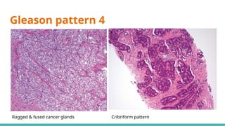 Prostate Pattern D MORPHOLOGICAL PATTERNS OF PROSTATE TUMORS.pptx