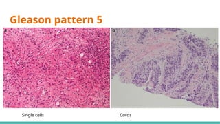 Prostate Pattern D MORPHOLOGICAL PATTERNS OF PROSTATE TUMORS.pptx