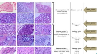 Prostate Pattern D MORPHOLOGICAL PATTERNS OF PROSTATE TUMORS.pptx