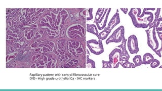Prostate Pattern D MORPHOLOGICAL PATTERNS OF PROSTATE TUMORS.pptx