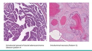 Prostate Pattern D MORPHOLOGICAL PATTERNS OF PROSTATE TUMORS.pptx