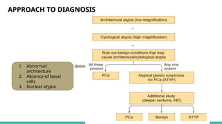 Prostate Pattern D MORPHOLOGICAL PATTERNS OF PROSTATE TUMORS.pptx