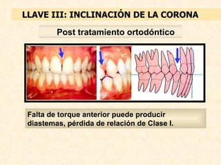 LLAVE III: INCLINACIÓN DE LA CORONA

         Post tratamiento ortodóntico




 Falta de torque anterior puede producir
 diastemas, pérdida de relación de Clase I.
 