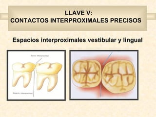 LLAVE V:
    CONTACTOS INTERPROXIMALES PRECISOS


•   Espacios interproximales vestibular y lingual
 