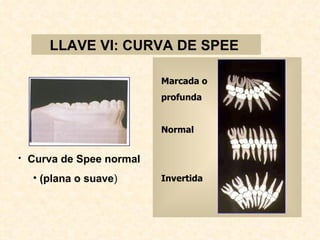 LLAVE VI: CURVA DE SPEE

                         Marcada o
                         profunda


                         Normal


• Curva de Spee normal

  • (plana o suave)      Invertida
 