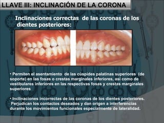 LLAVE IV:
AUSENCIA DE ROTACIONES
Las rotaciones son alteraciones de
posición de los dientes como
consecuencia de giroversi...