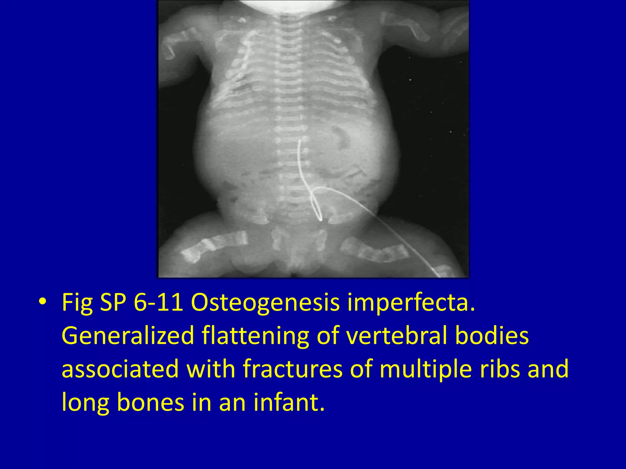 • Fig SP 6-11 Osteogenesis imperfecta.
Generalized flattening of vertebral bodies
associated with fractures of multiple ribs and
long bones in an infant.
 