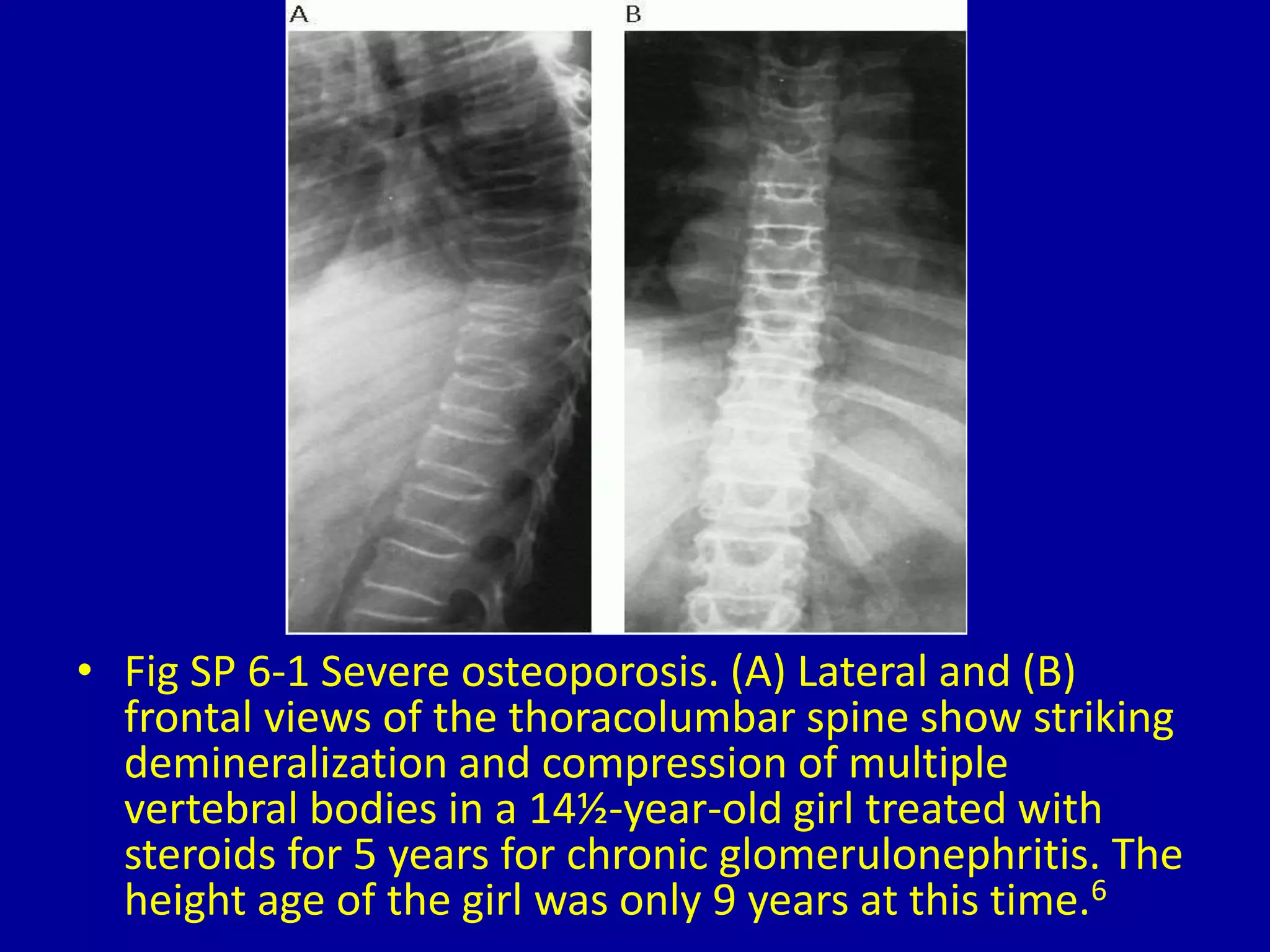 • Fig SP 6-1 Severe osteoporosis. (A) Lateral and (B)
frontal views of the thoracolumbar spine show striking
demineralization and compression of multiple
vertebral bodies in a 14½-year-old girl treated with
steroids for 5 years for chronic glomerulonephritis. The
height age of the girl was only 9 years at this time.6
 