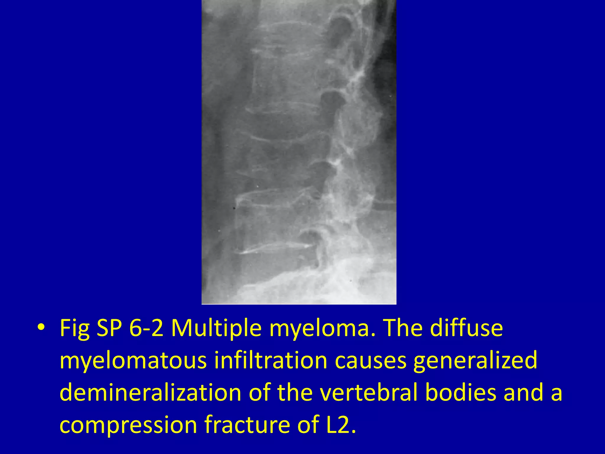 • Fig SP 6-2 Multiple myeloma. The diffuse
myelomatous infiltration causes generalized
demineralization of the vertebral bodies and a
compression fracture of L2.
 