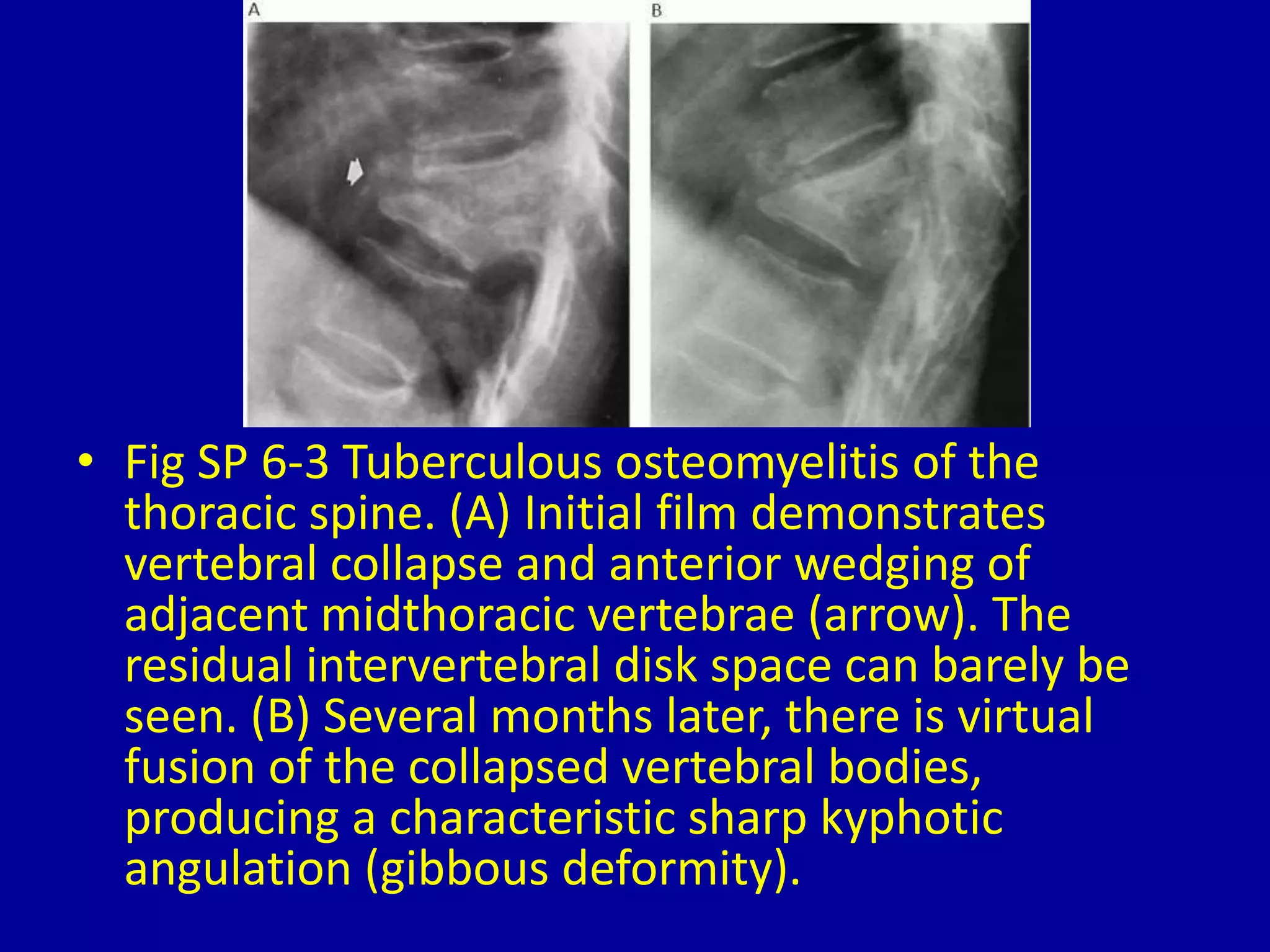 • Fig SP 6-3 Tuberculous osteomyelitis of the
thoracic spine. (A) Initial film demonstrates
vertebral collapse and anterior wedging of
adjacent midthoracic vertebrae (arrow). The
residual intervertebral disk space can barely be
seen. (B) Several months later, there is virtual
fusion of the collapsed vertebral bodies,
producing a characteristic sharp kyphotic
angulation (gibbous deformity).
 