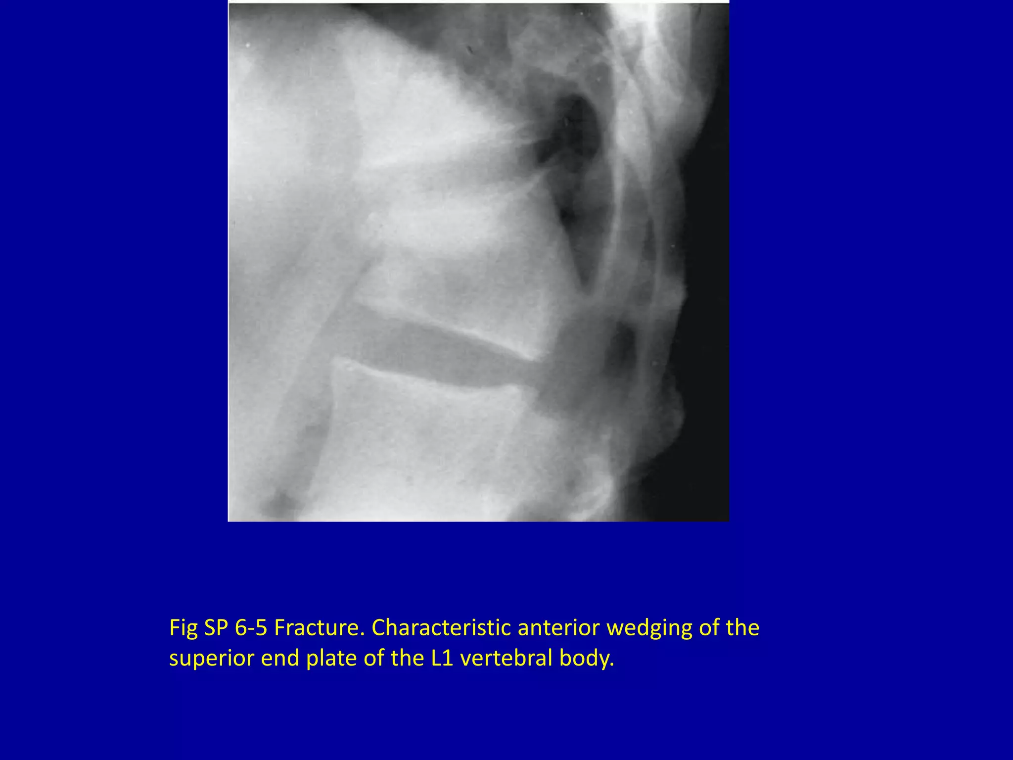 Fig SP 6-5 Fracture. Characteristic anterior wedging of the
superior end plate of the L1 vertebral body.
 