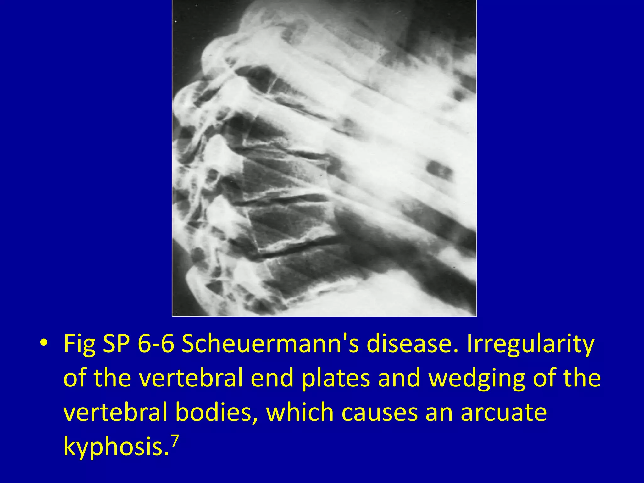 • Fig SP 6-6 Scheuermann's disease. Irregularity
of the vertebral end plates and wedging of the
vertebral bodies, which causes an arcuate
kyphosis.7
 