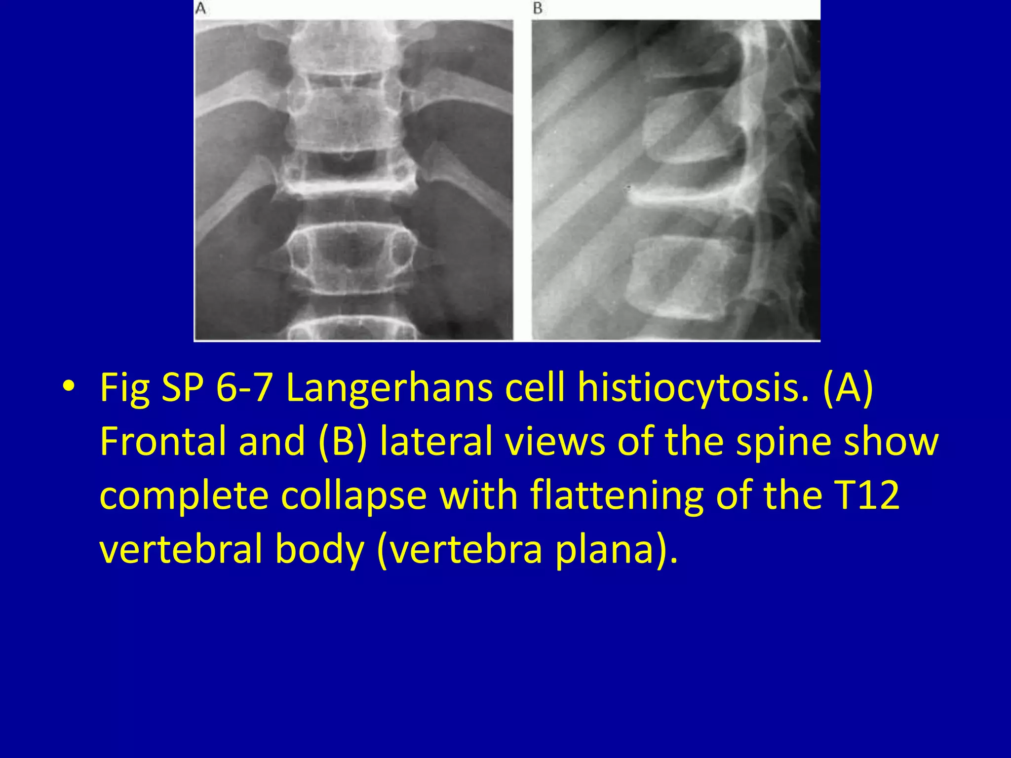 • Fig SP 6-7 Langerhans cell histiocytosis. (A)
Frontal and (B) lateral views of the spine show
complete collapse with flattening of the T12
vertebral body (vertebra plana).
 