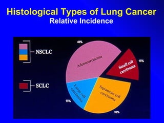 Histological Types of Lung Cancer Relative Incidence 
