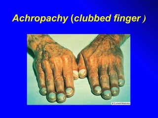 Achropachy  ( clubbed finger   ) 