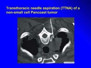 Transthoracic needle aspiration (TTNA) of a non-small cell Pancoast tumor 