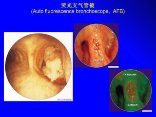 荧光支气管镜 ( Auto fluorescence  bronchoscope,  AFB) 