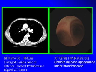 隆突前可见一淋巴结 Enlarged Lymph node of  Inferior Tracheal Protuberance  (Spiral CT Scan ) 支气管镜下粘膜表面光滑 Smooth mucosa appearance under bronchoscope 