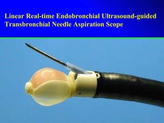 (BF-UC160F-OL8; Olympus Medical Systems, Tokyo, Japan) Linear Real-time Endobronchial Ultrasound-guided  Transbronchial Needle Aspiration Scope 