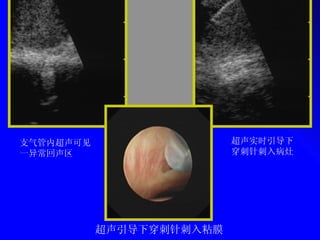 支气管内超声可见一异常回声区 超声引导下穿刺针刺入粘膜 超声实时引导下穿刺针刺入病灶 