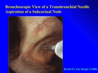 Bronchoscopic View of a Transbronchial Needle  Aspiration of a Subcarinal Node Herth FJ. Eur Respir J 2006 