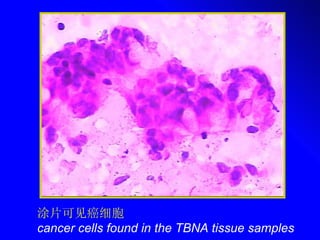 涂片可见癌细胞 cancer cells found in the TBNA tissue samples 
