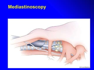 Mediastinoscopy 