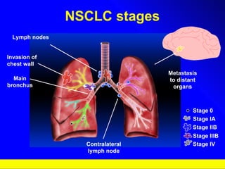NSCLC stages Stage 0 Stage IA Stage IIB Stage IIIB Stage IV Lymph nodes Main bronchus Contralateral lymph node Metastasis to distant organs Invasion of chest wall 