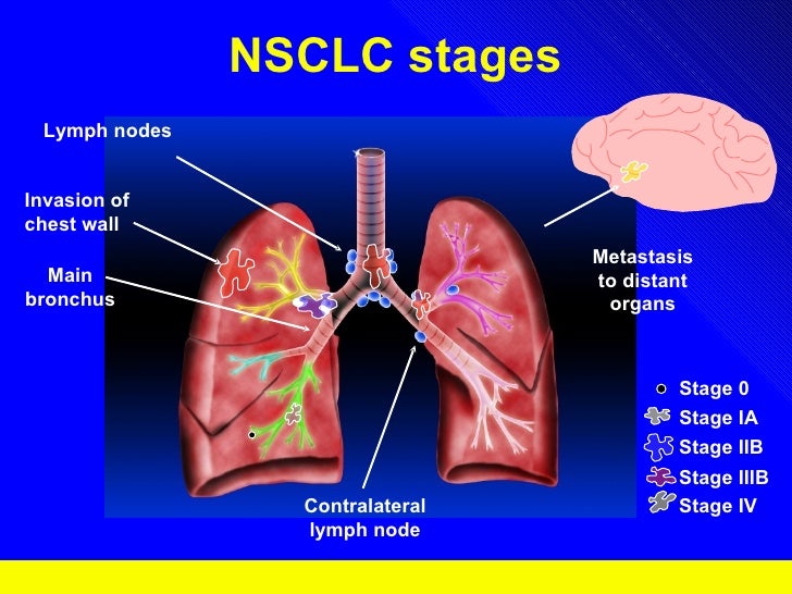 6 lungcancer diagram of squamous cell carcinoma 