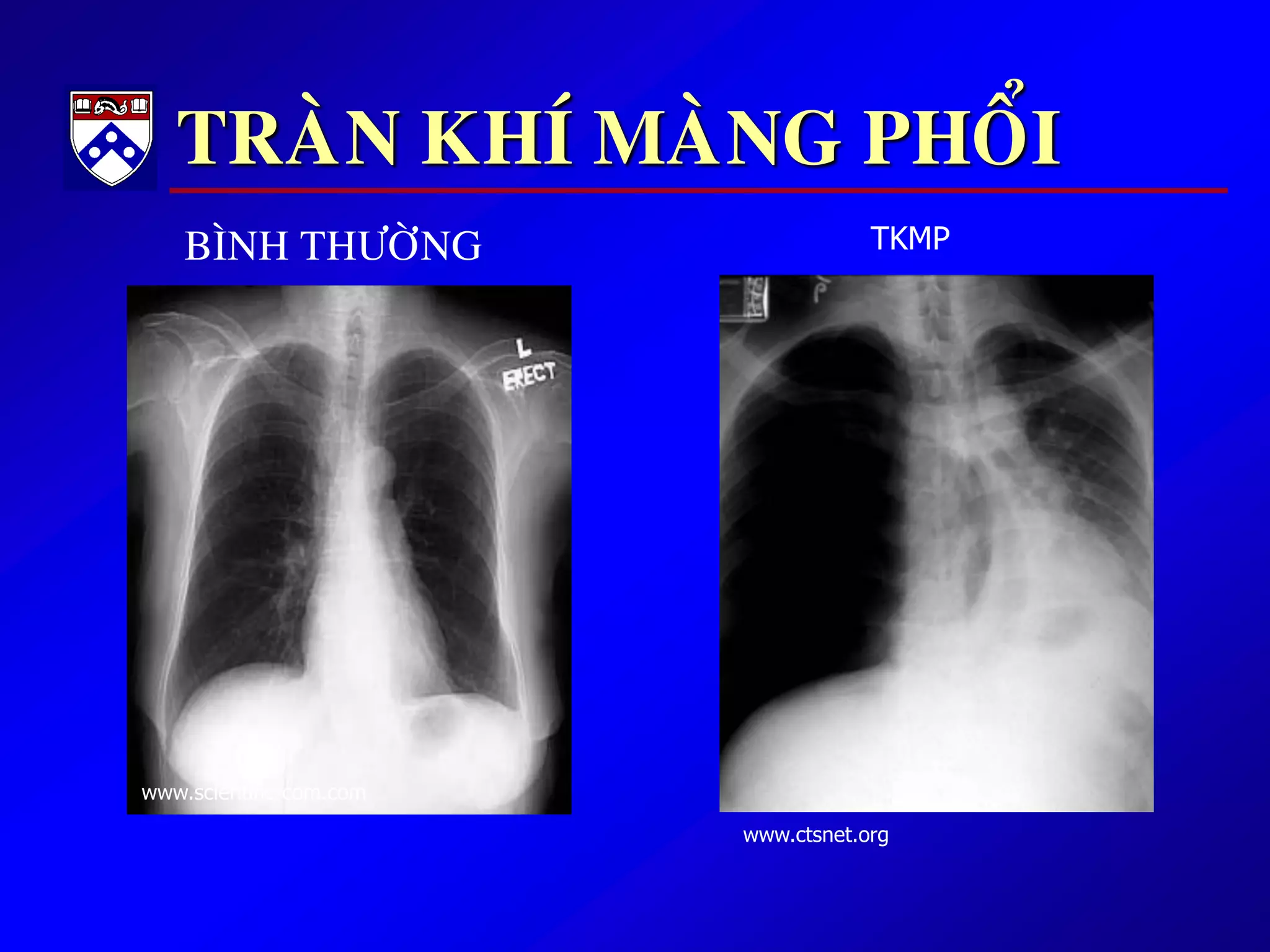 TRAØN KHÍ MAØNG PHOÅI
www.ctsnet.org
www.scientific-com.com
BÌNH THÖÔØNG TKMP
 