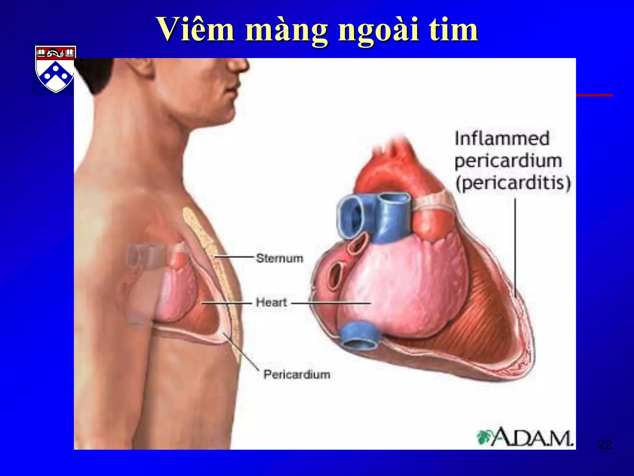 22
Viêm màng ngoài tim
 