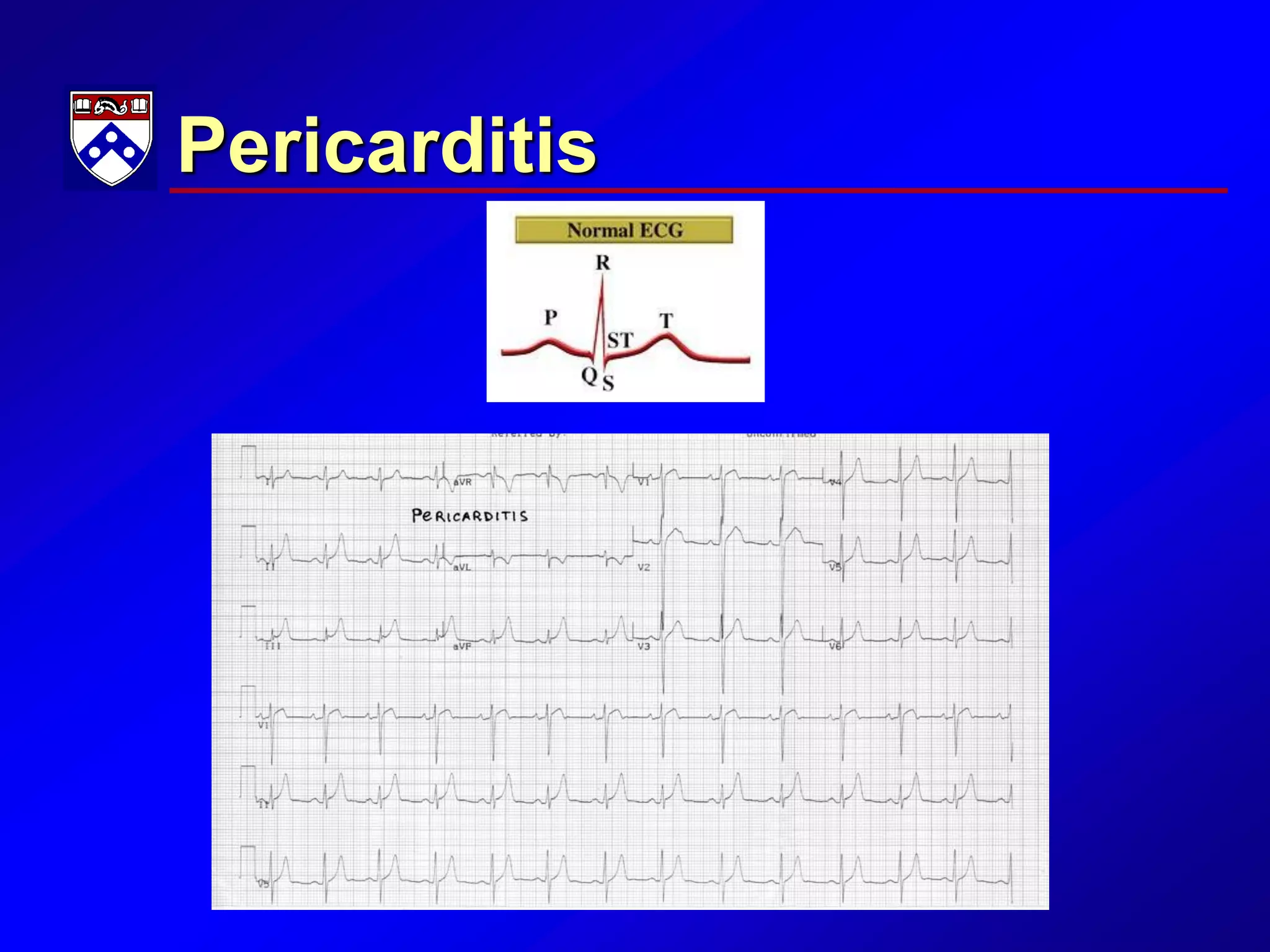 Pericarditis
 