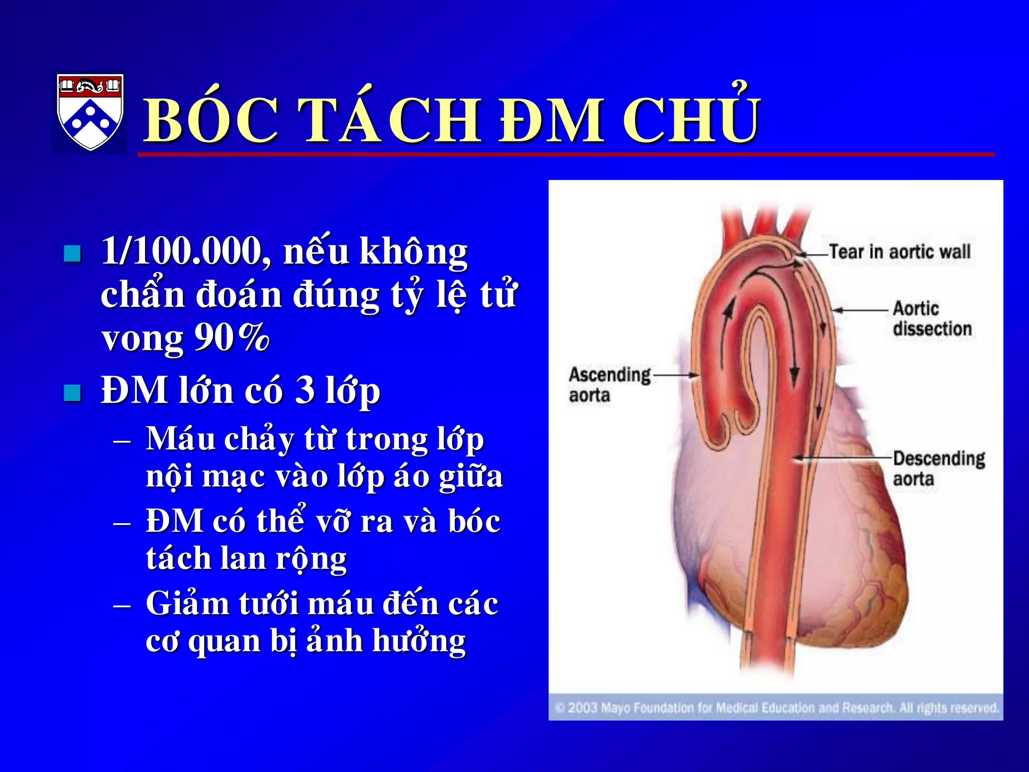 BOÙC TAÙCH ÑM CHUÛ
 1/100.000, neáu khoâng
chaån ñoaùn ñuùng tyû leä töû
vong 90%
 ÑM lôùn coù 3 lôùp
– Maùu chaûy töø trong lôùp
noäi maïc vaøo lôùp aùo giöõa
– ÑM coù theå vôõ ra vaø boùc
taùch lan roäng
– Giaûm töôùi maùu ñeán caùc
cô quan bò aûnh höôûng
 
