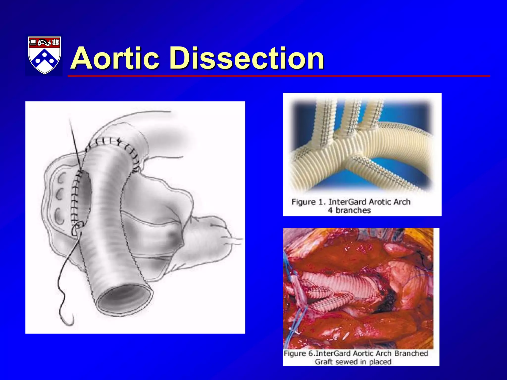Aortic Dissection
 
