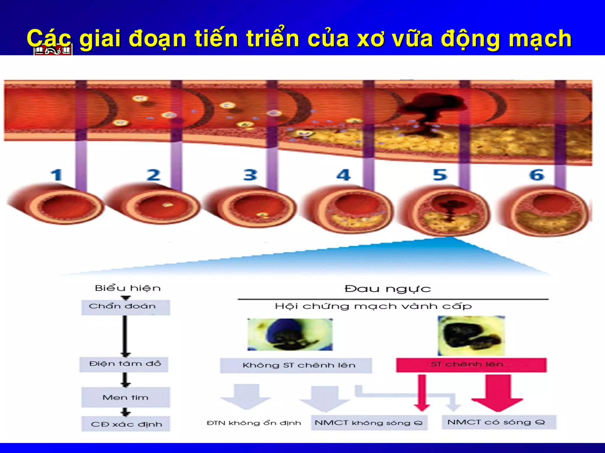 Caùc giai ñoaïn tieán trieån cuûa xô vöõa ñoäng maïch
 