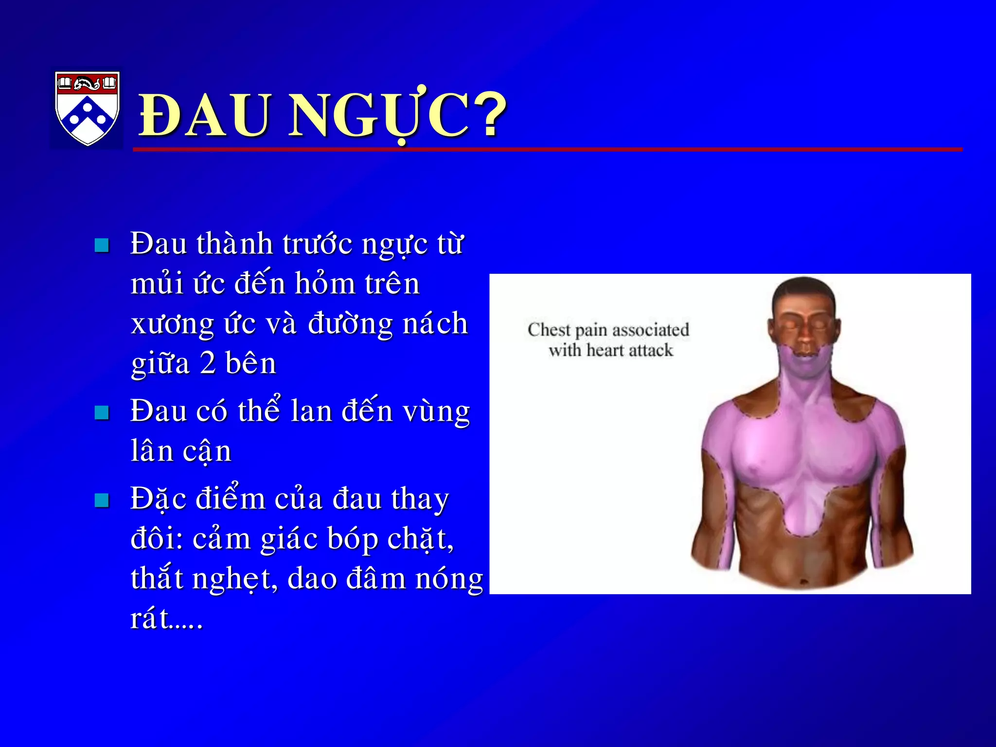 ÑAU NGÖÏC?
 Ñau thaønh tröôùc ngöïc töø
muûi öùc ñeán hoûm treân
xöông öùc vaø ñöôøng naùch
giöõa 2 beân
 Ñau coù theå lan ñeán vuøng
laân caän
 Ñaëc ñieåm cuûa ñau thay
ñoâi: caûm giaùc boùp chaët,
thaét ngheït, dao ñaâm noùng
raùt…..
 