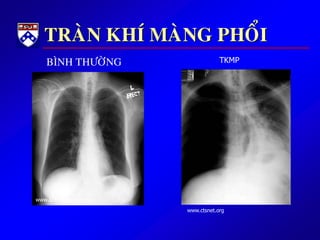 TRAØN KHÍ MAØNG PHOÅI
www.ctsnet.org
www.scientific-com.com
BÌNH THÖÔØNG TKMP
 