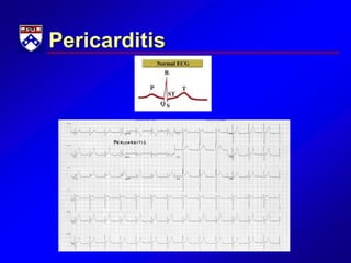 Pericarditis
 