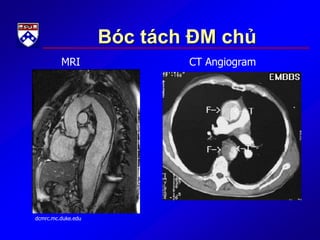 Bóc tách ĐM chủ
MRI CT Angiogram
dcmrc.mc.duke.edu
 