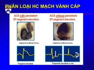 PHÂN LOẠI HC MẠCH VÀNH CẤP
 