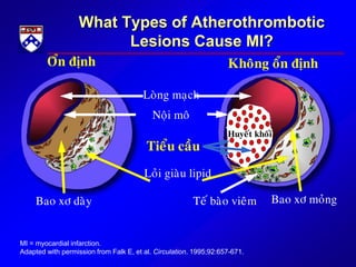 Noäi moâ
Loûi giaøu lipid
Bao xô daøy Bao xô moûngTeá baøo vieâm
Loøng maïch
MI = myocardial infarction.
Adapted with permission from Falk E, et al. Circulation. 1995;92:657-671.
Tieåu caàu
Oån ñònh Khoâng oån ñònh
What Types of Atherothrombotic
Lesions Cause MI?
Huyeát khoái
 