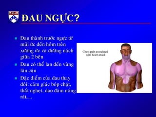 ÑAU NGÖÏC?
 Ñau thaønh tröôùc ngöïc töø
muûi öùc ñeán hoûm treân
xöông öùc vaø ñöôøng naùch
giöõa 2 beân
 Ñau coù theå lan ñeán vuøng
laân caän
 Ñaëc ñieåm cuûa ñau thay
ñoâi: caûm giaùc boùp chaët,
thaét ngheït, dao ñaâm noùng
raùt…..
 