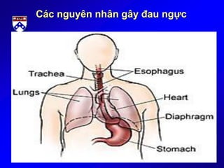 Các nguyên nhân gây đau ngực
 