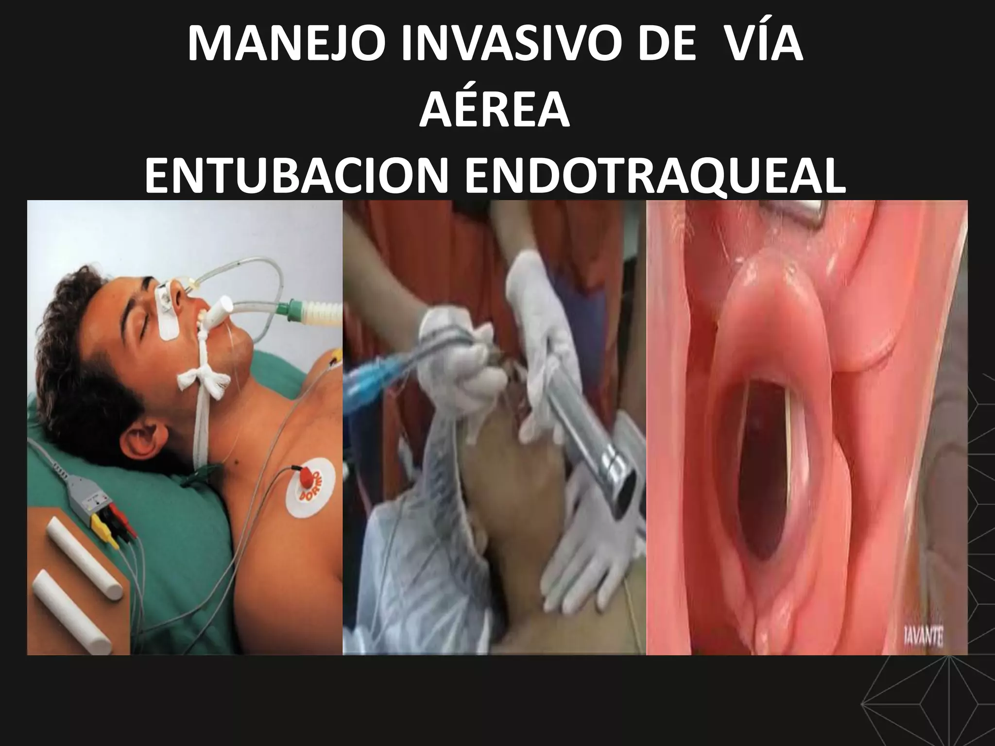 6 MANEJO INVASIVO DE LA VIA AEREA.pdf