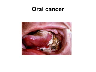 Oral cancer

 
