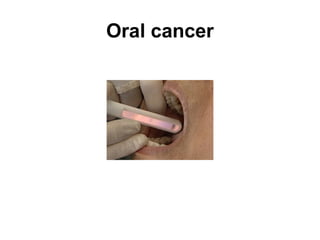 Oral cancer

 