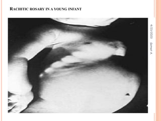 RACHITIC ROSARY IN A YOUNG INFANT
4/23/2023
43
Getnet
A.
 