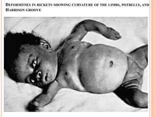 DEFORMITIES IN RICKETS SHOWING CURVATURE OF THE LIMBS, POTBELLY, AND
HARRISON GROOVE
4/23/2023
44
Getnet
A.
 